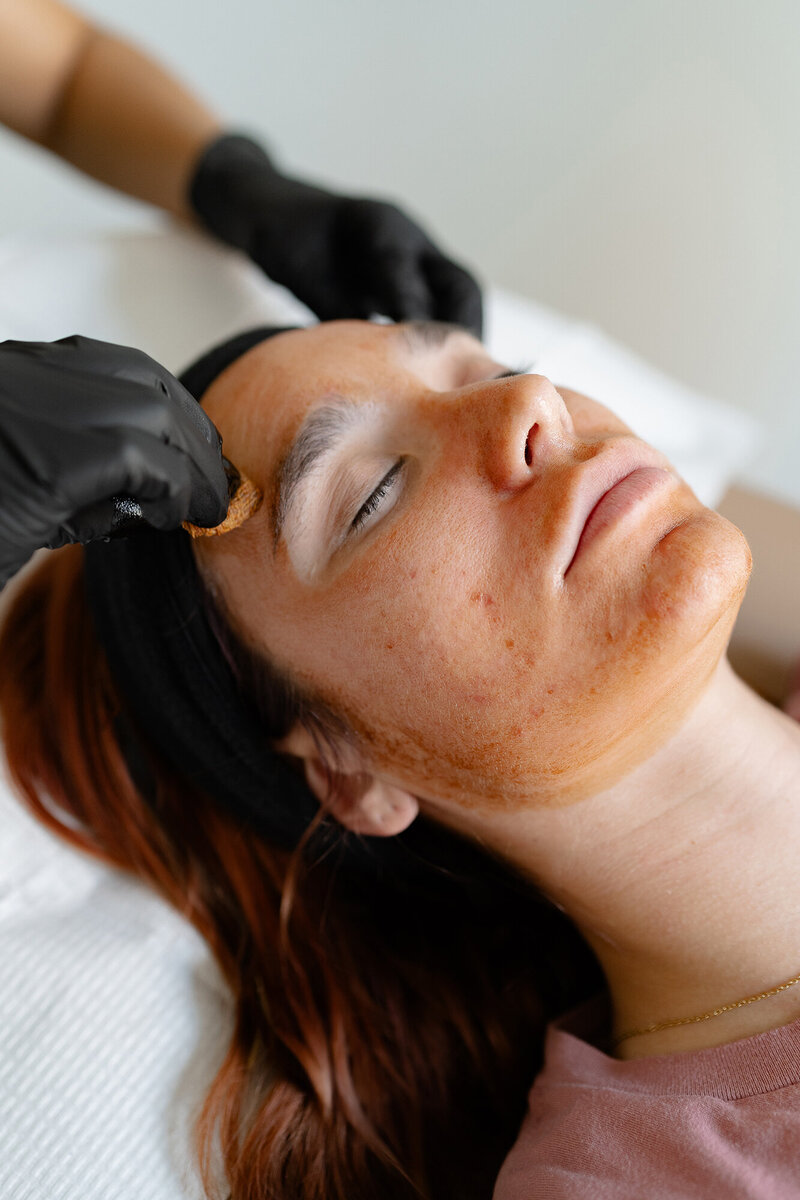 charleston chemical peel 2