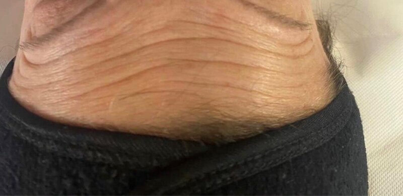 carbonpeel soins esthétique