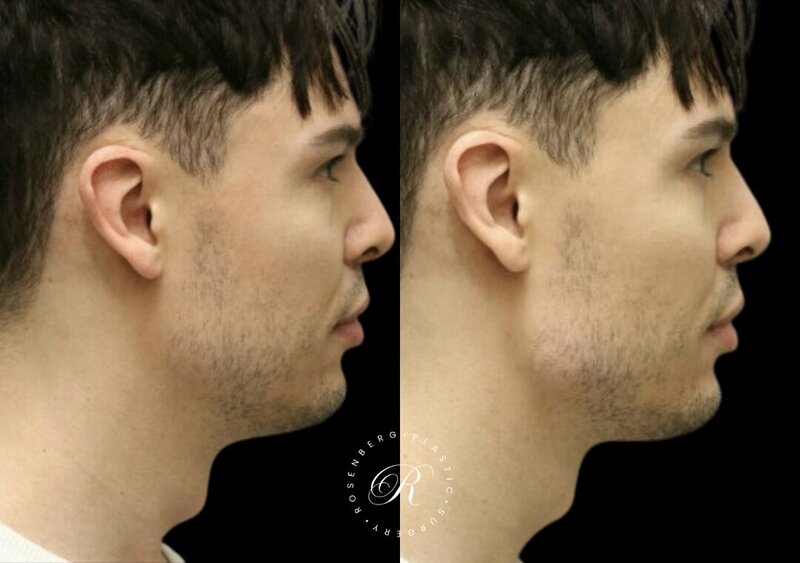 Non-surgical ChinJaw Augmentation RPS Before & After.zip - 19