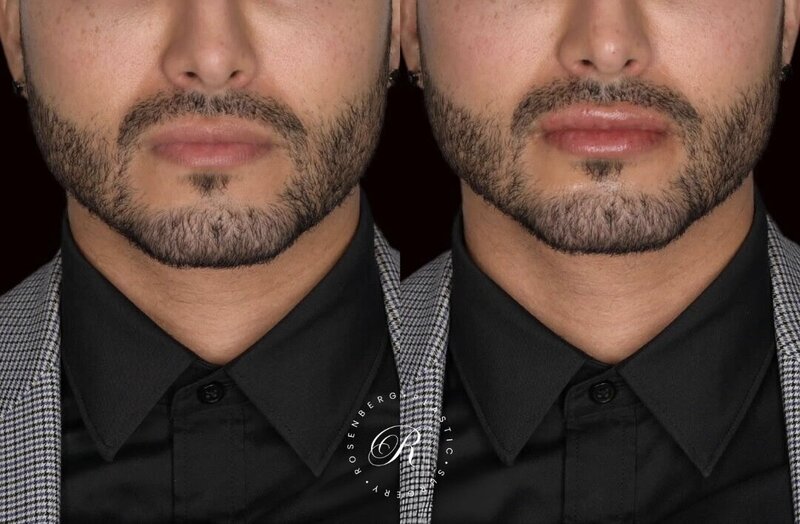 Non-surgical ChinJaw Augmentation RPS Before & After.zip - 25