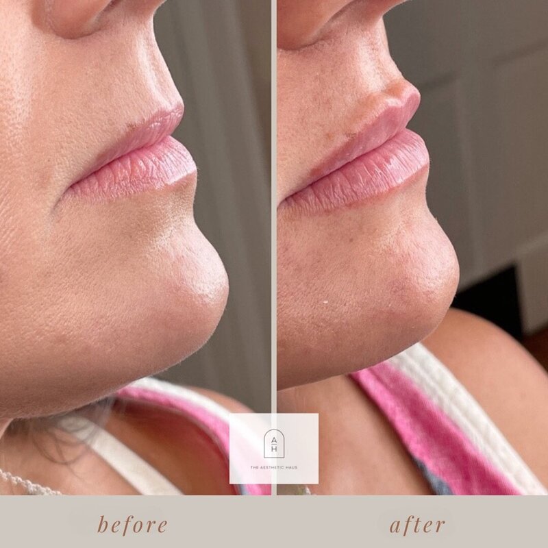 Alli - Juve - Lip Filler 1.1