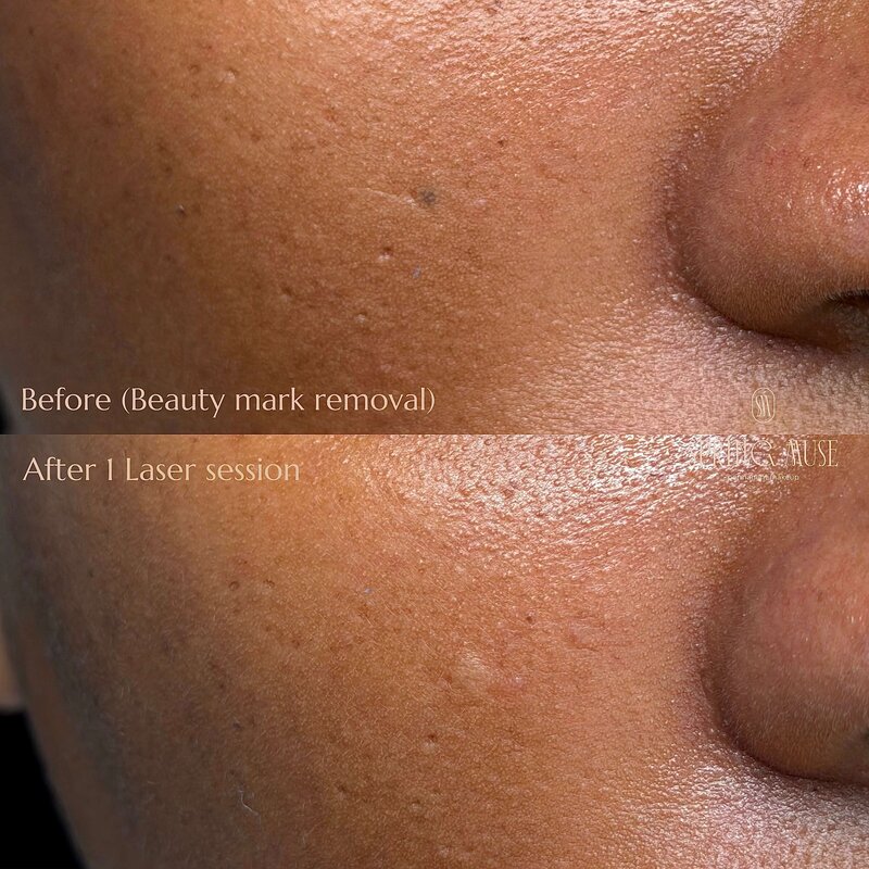 Laser Eyebrows Removal New York