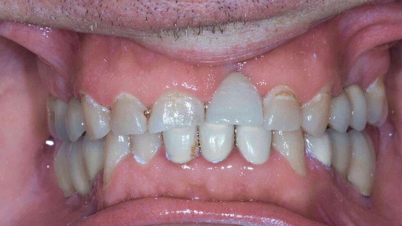 Example 1- a close up shot of the teeth  after getting implants