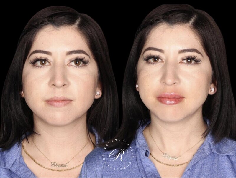 Non-surgical Lip Augmentation RPS Before & Afters.png