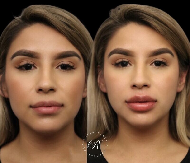 Non-surgical Lip Augmentation RPS Before & Afters.zip - 21