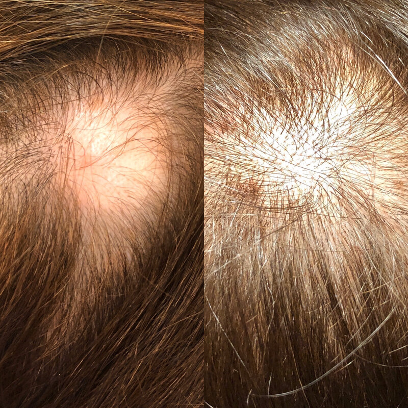 BeautyInScienceMEdspa_hair regrowth