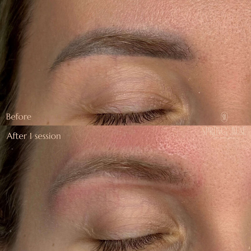 Laser Powder Eyebrows Removal New York