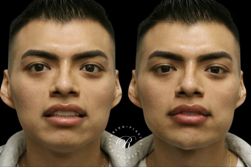 Non-surgical ChinJaw Augmentation RPS Before & After.zip - 1