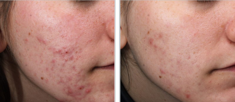 Transformation with ClearSilk™: improved skin texture and reduced acne.