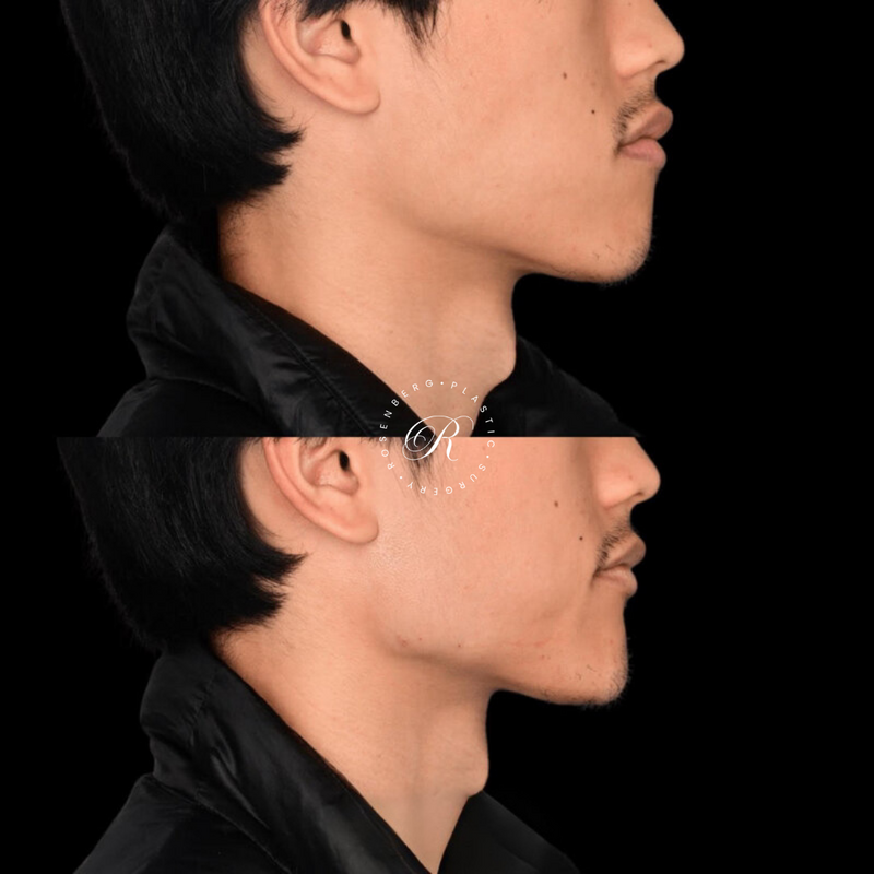 Non-surgical ChinJaw Augmentation RPS Before & After.zip - 47
