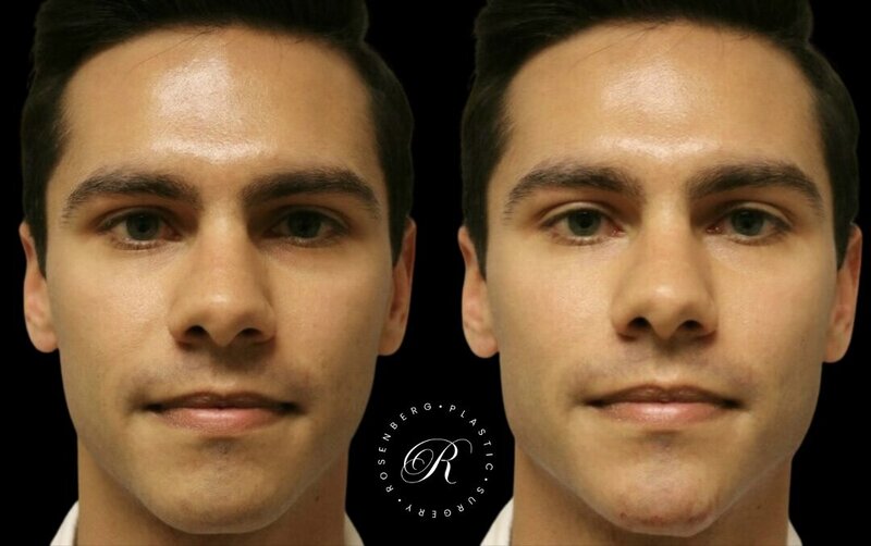 Non-surgical ChinJaw Augmentation RPS Before & After.zip - 21