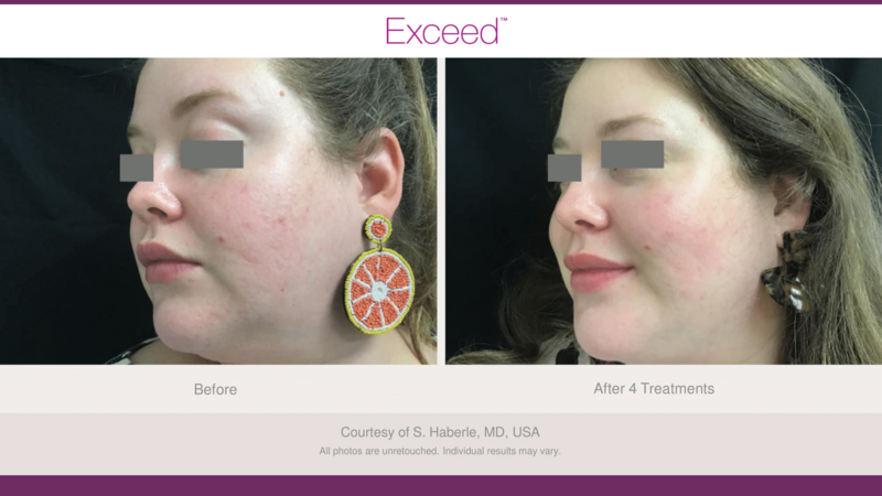 Candela Exceed before and after photo face