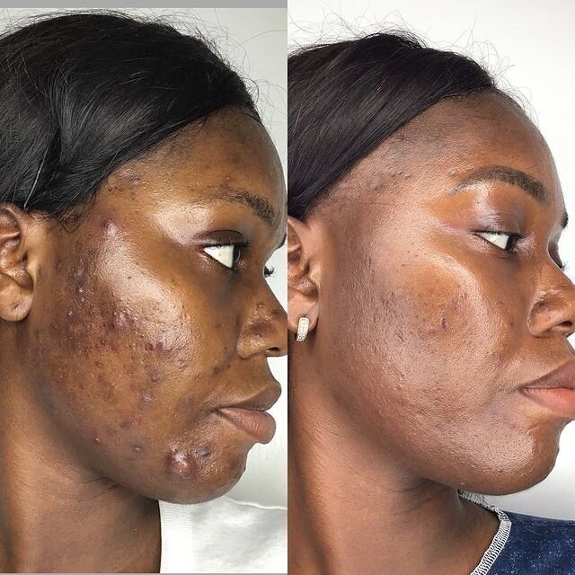 Acne by Aerolase (11)