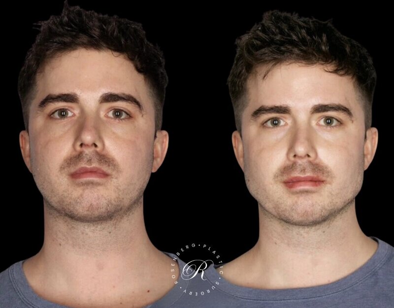 Non-surgical ChinJaw Augmentation RPS Before & After 4.png