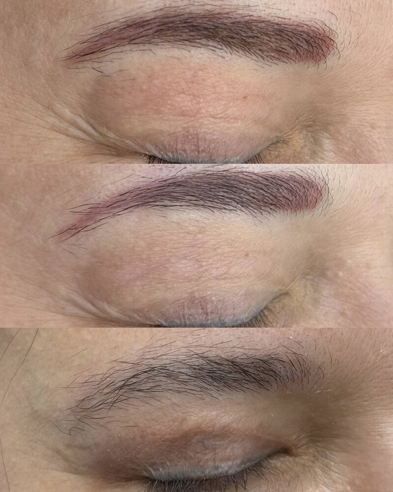 acid removal steps