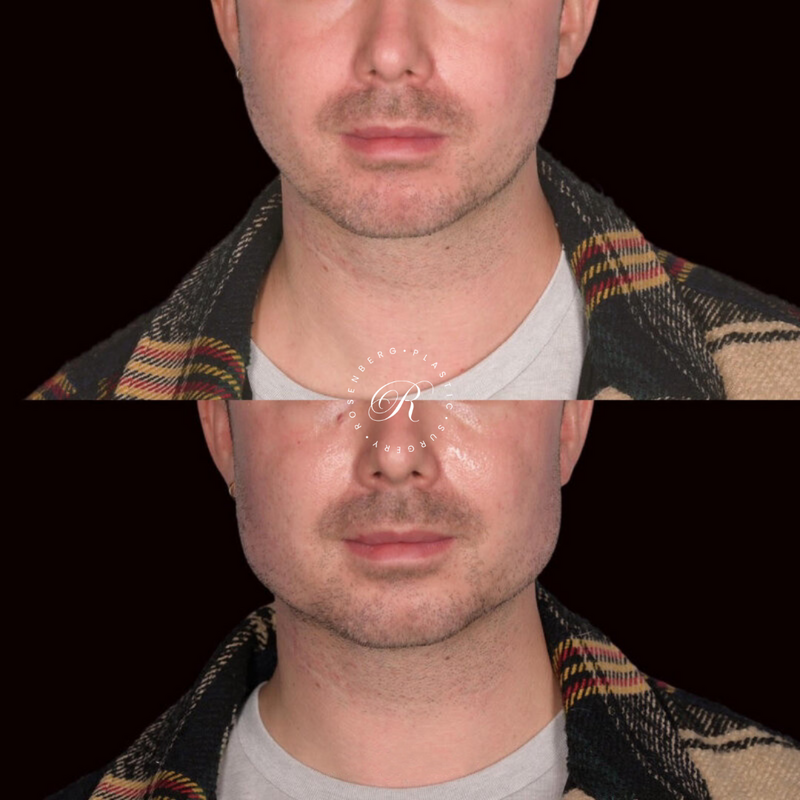 Non-surgical ChinJaw Augmentation RPS Before & After.zip - 48