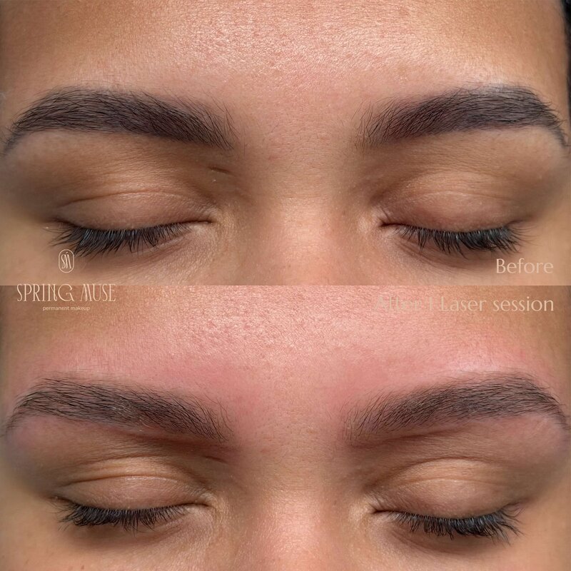 Laser Eyebrows Removal New York