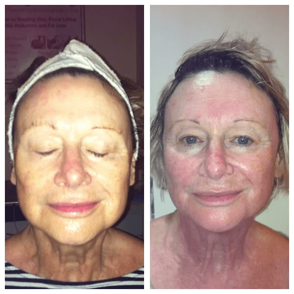 Veus-Freeze-skin-tightening-before-and-after-1