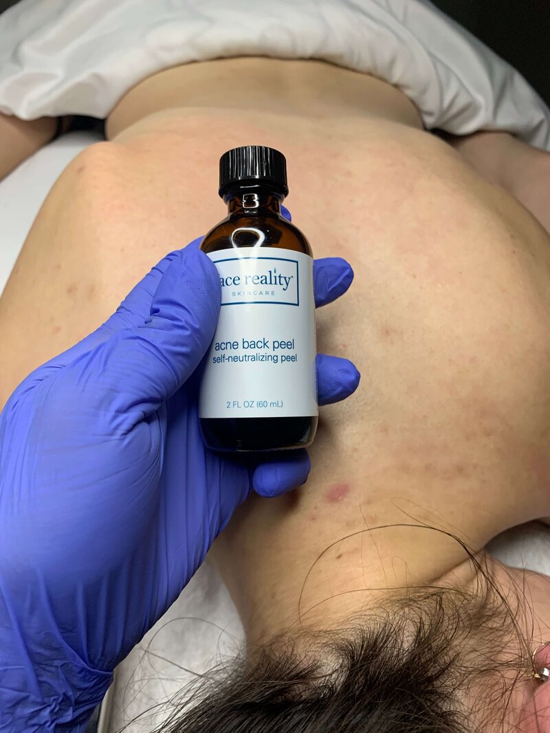 Back Peel on Client