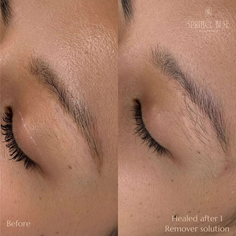 Yellow eyebrows removal NYC