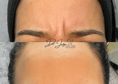 Botox.-Line-between-eyes.-Vertical-11-before-and-after-400x284