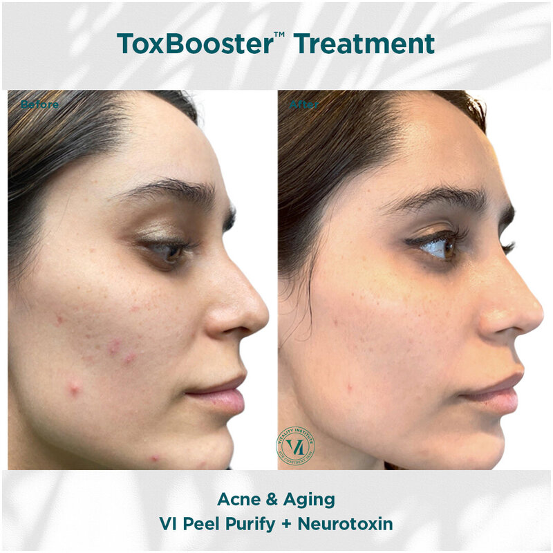 Acne _ Aging(1)