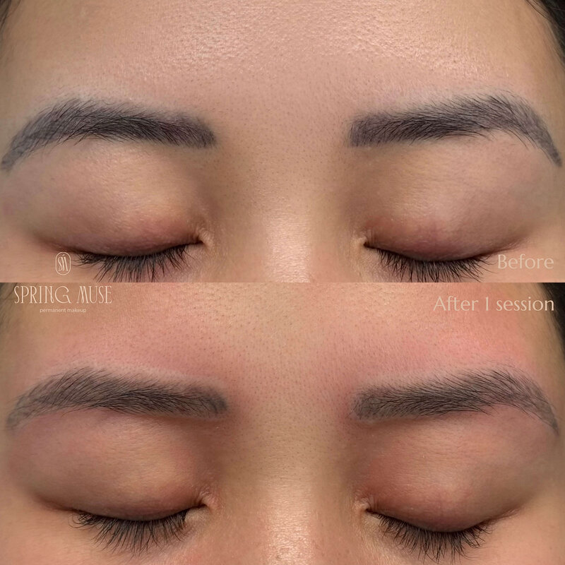 Laser Eyebrows Removal New York
