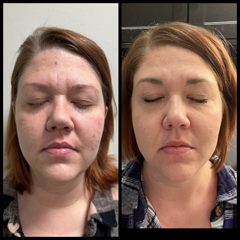 Sculptra Injection before and after