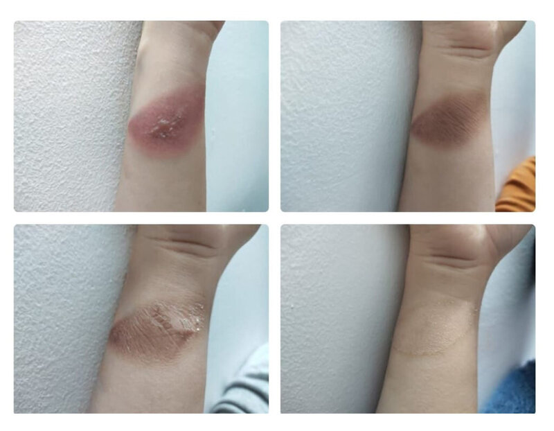avant après du jet peel