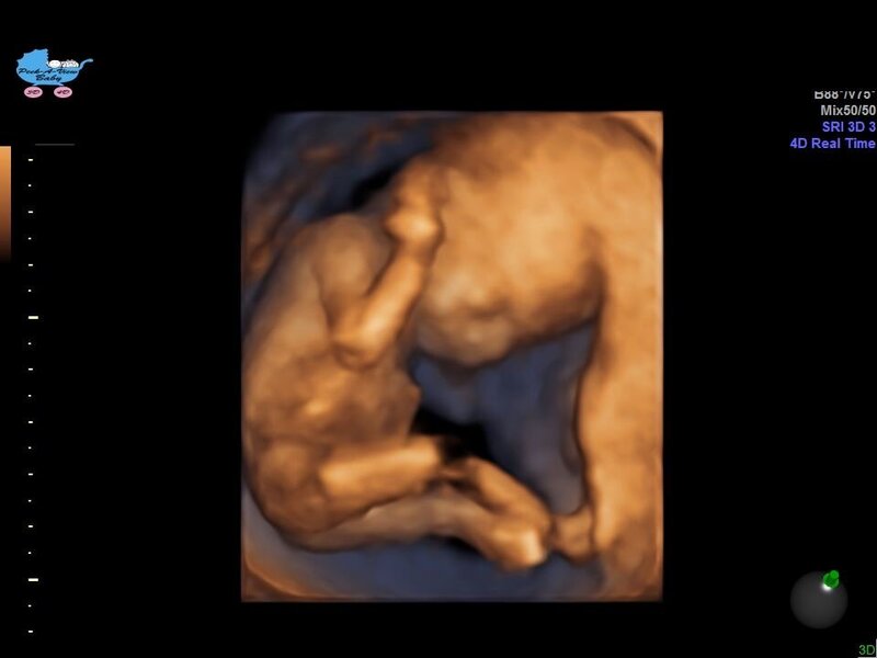 8 week ultrasound 3d twins