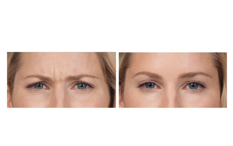 Frown lines B&A
