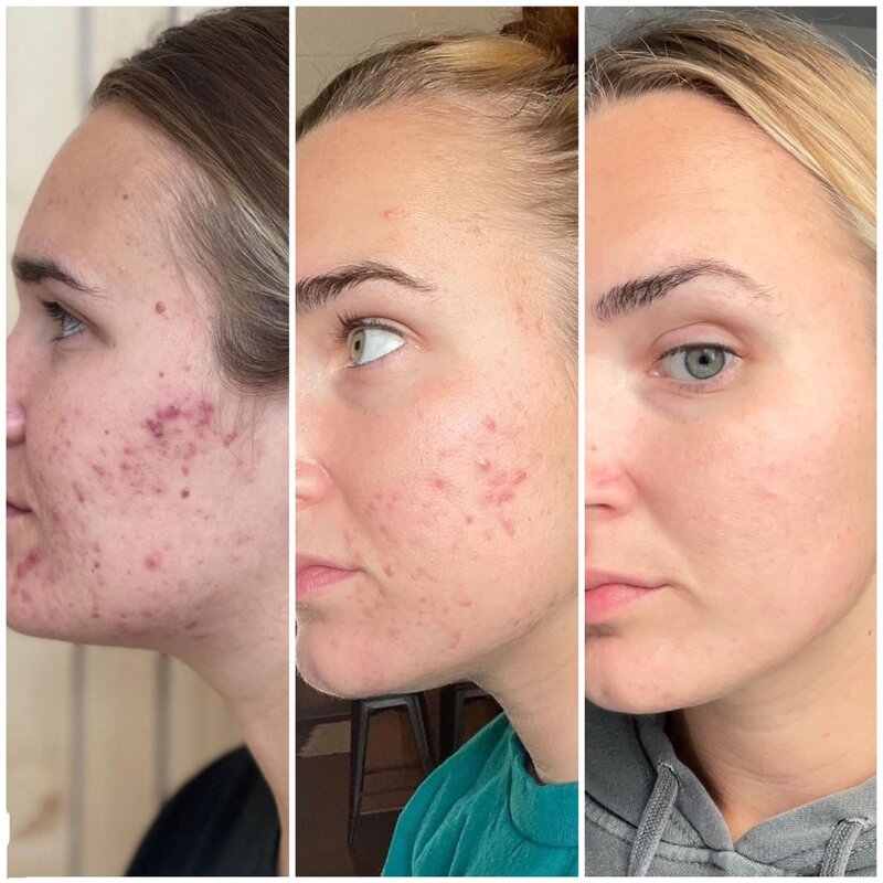acne client results columbus ohio