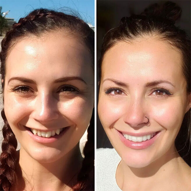 invisalign-before-after2