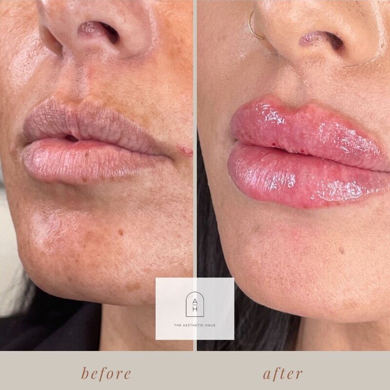 Lip FIller