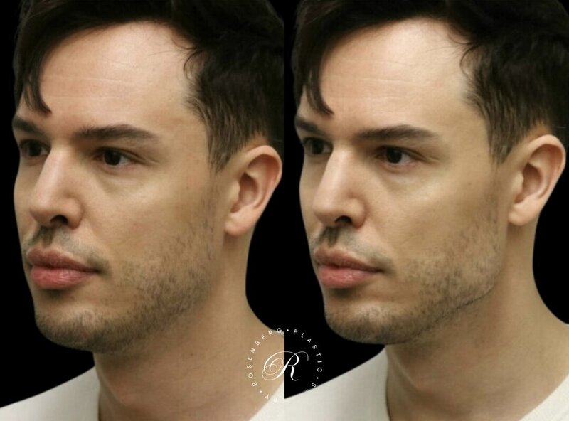 Non-surgical ChinJaw Augmentation RPS Before & After.zip - 18