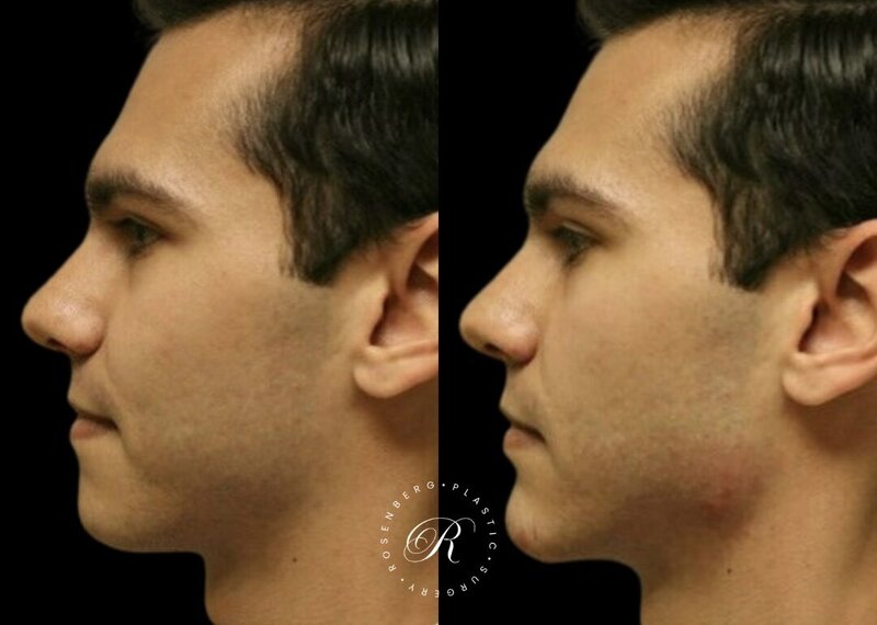 Non-surgical ChinJaw Augmentation RPS Before & After.zip - 20