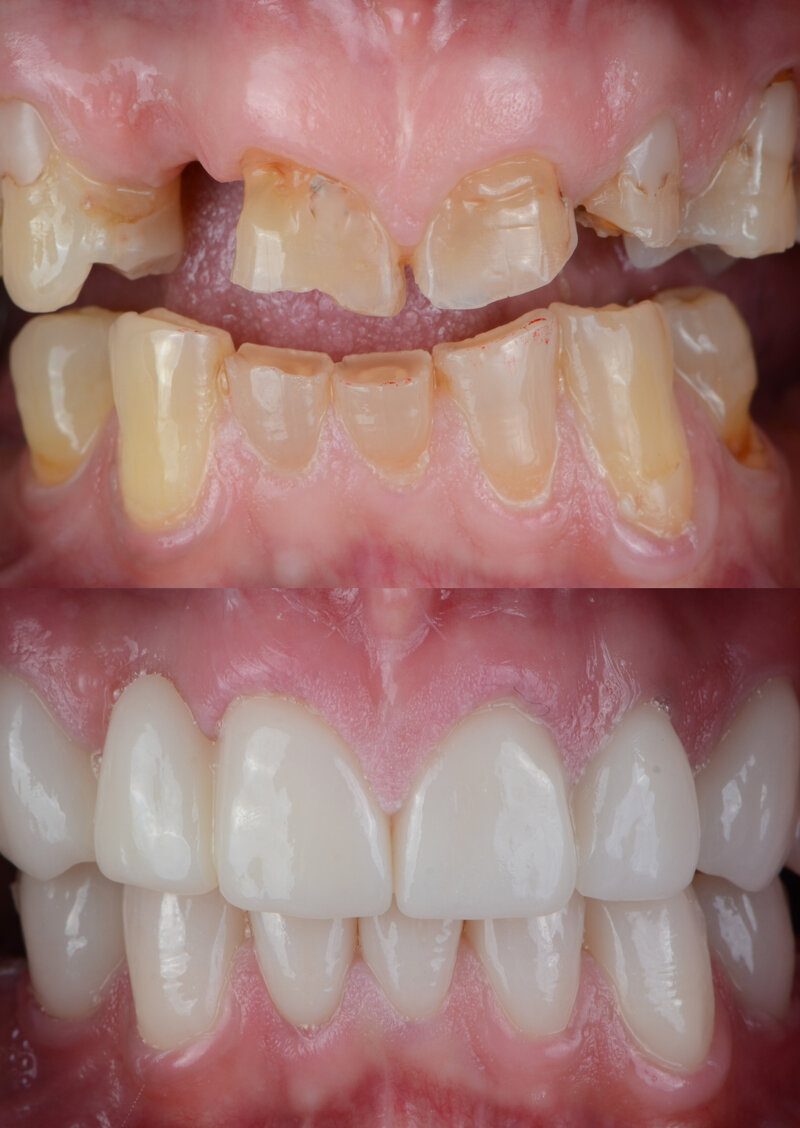 Before and after photos showing the results for a better smile with veneers and crowns.