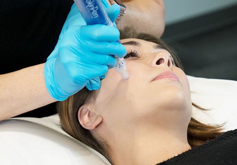 Woman having microneedling on cheek