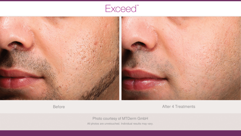 Candela Exceed before and after photo face