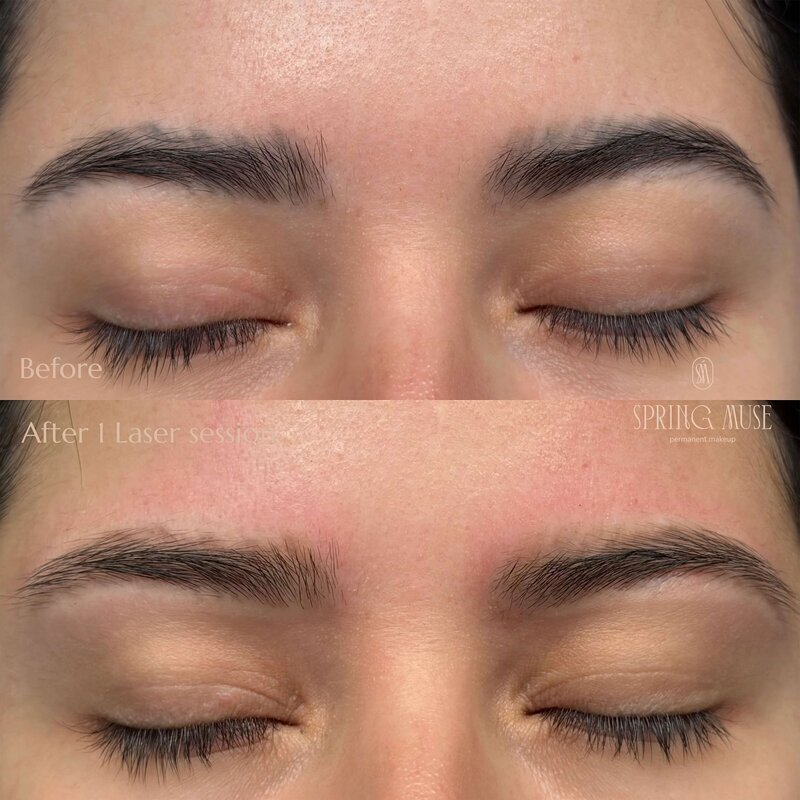 Laser Eyebrows Removal New York
