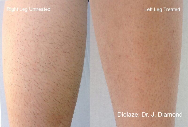 Womans legs before and after lazer hair removal