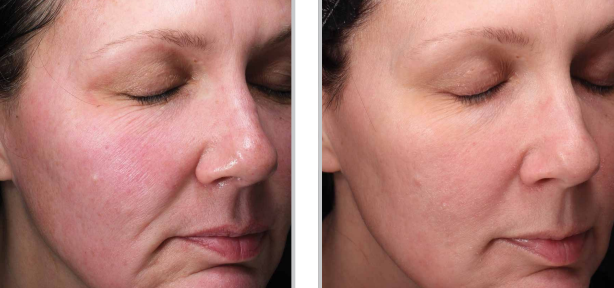 Skin transformation captured before and after MOXI laser, highlighting refreshed, luminous skin
