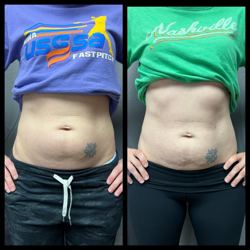 Emsculpt before and after photo of tummy