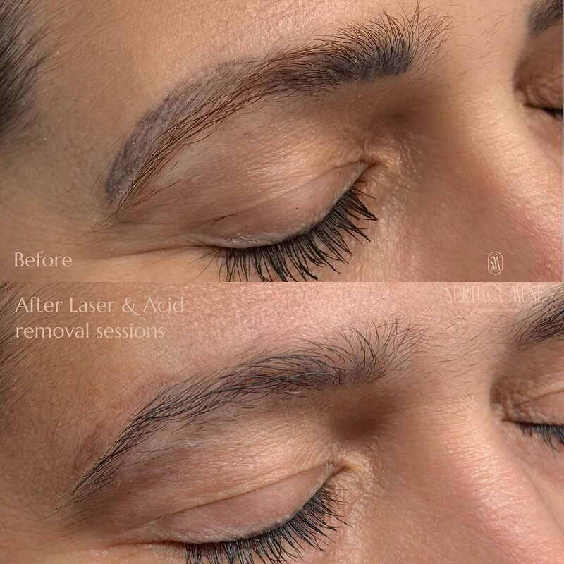 Acid and Laser removal nyc