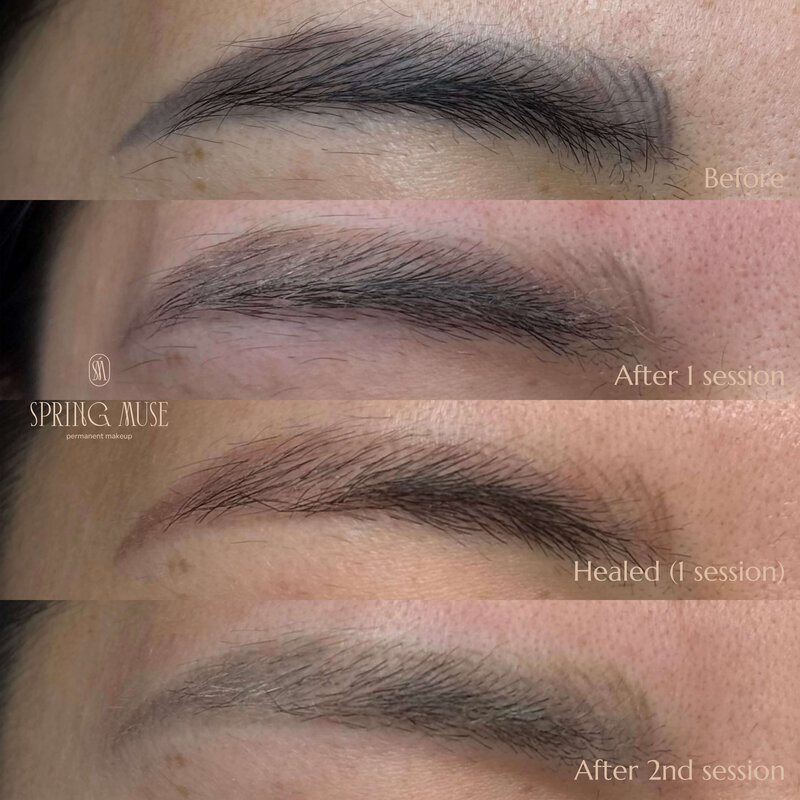 Laser Eyebrows Removal New York