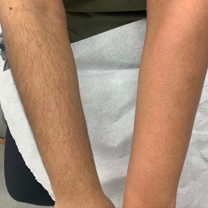 Before and after photo of a waxed arm