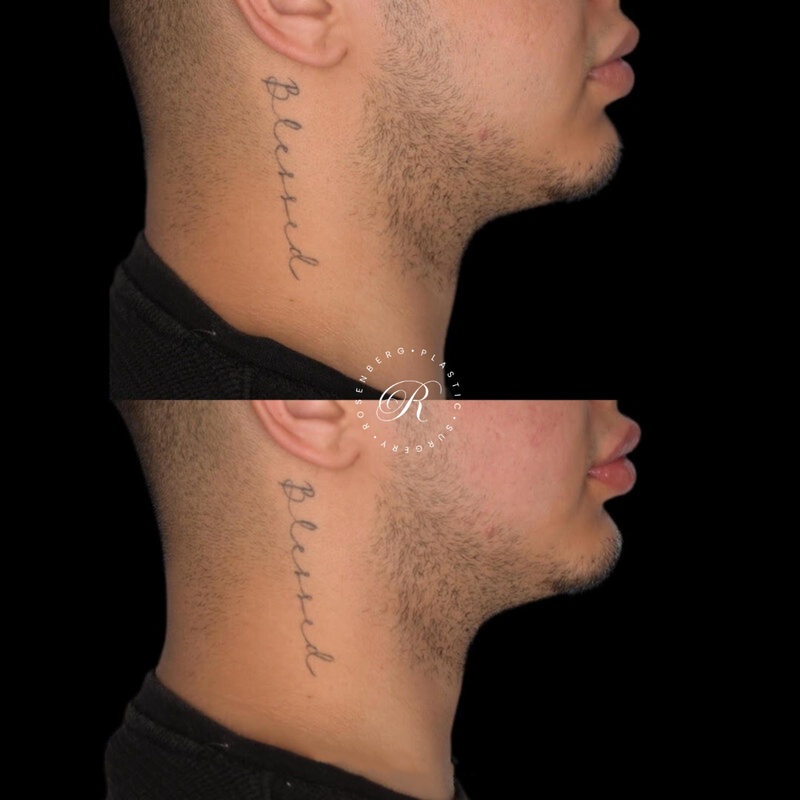 Non-surgical Lip Augmentation RPS Before & Afters.zip - 12