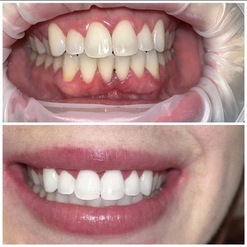 Before and after of teeth whitening
