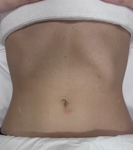 Before a client received a full body lymphatic drainage massage