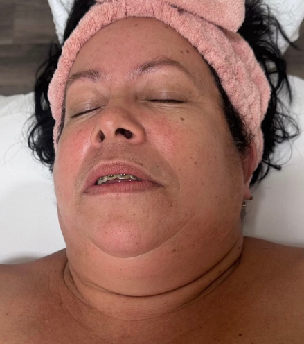 A women before she had a face lymphatic drainage massage